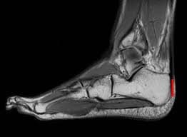 MRI Foot